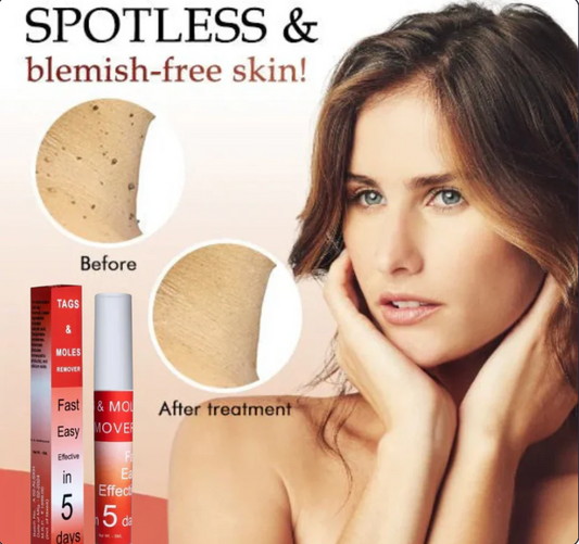 LOVILDS™ Tags & Moles Remover (Buy 1 Get 1 Free🔥🔥)